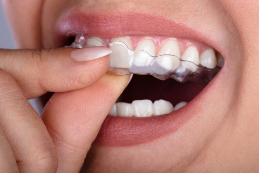 Invisalign Vermont